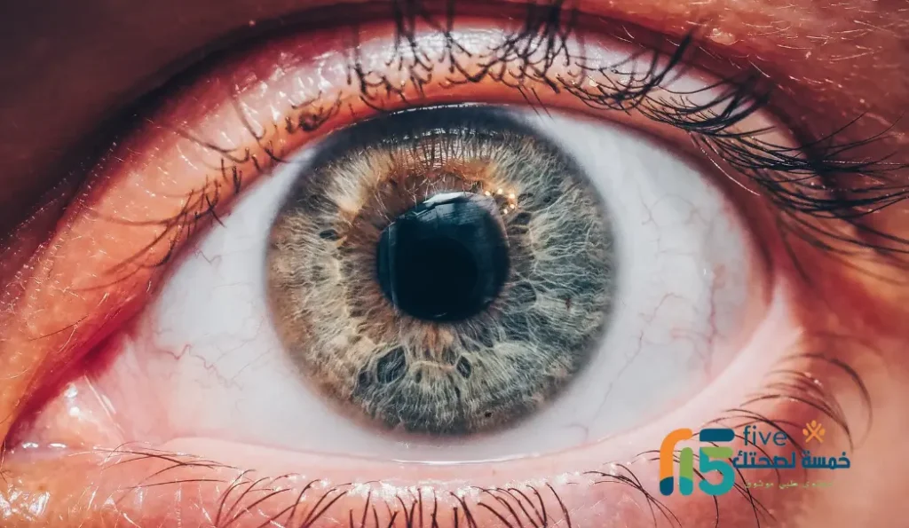 التهاب العنبية.. أسرار الالتهاب وأعراضه وعلاجه - تفاصيل التهاب العنبية