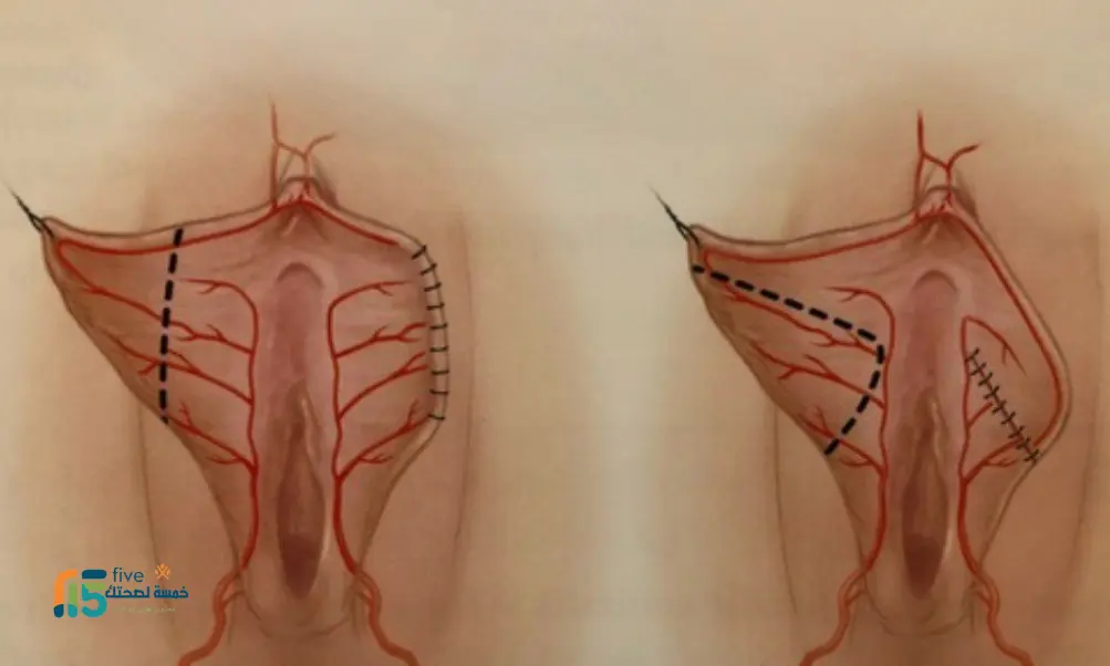 عملية تجميل الشفرتين قبل وبعد .. من المعاناة إلى الراحة عملية تجميل الشفرتين قبل وبعد