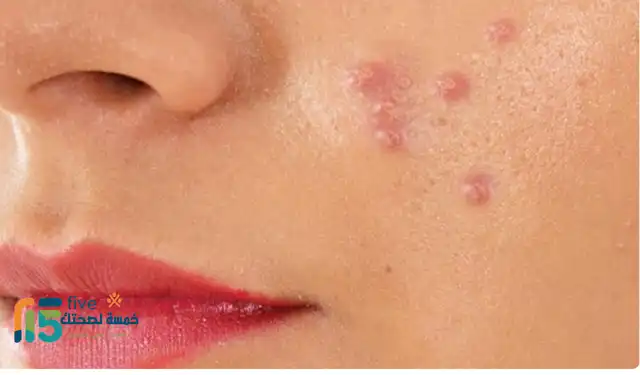 علاج حب الشباب طبيعياً بسرعة بالمنزل..بشرة خالية من العيوب علاج حب الشباب طبيعياً بسرعة بالمنزل