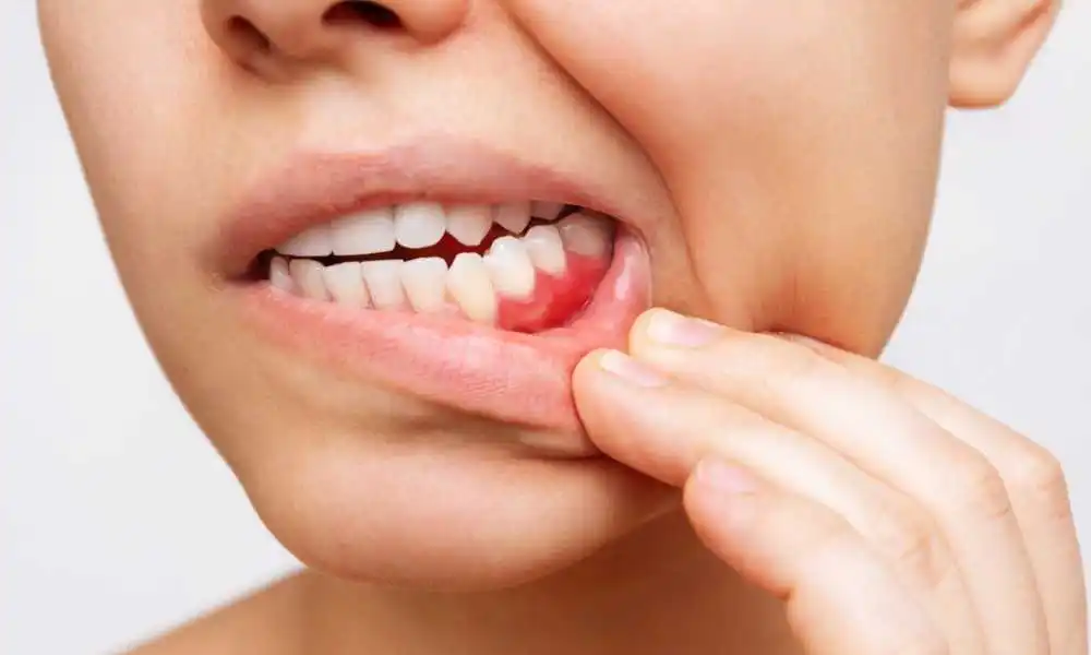 أفضل مضاد حيوي لعلاج التهاب اللثة .. تعرف عليه أفضل مضاد حيوي لعلاج التهاب اللثة