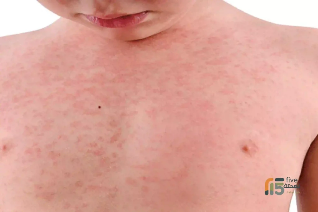 أعراض الحصبة: كيف تكتشف المرض مبكرًا وتحمي نفسك وعائلتك أعراض الحصبة